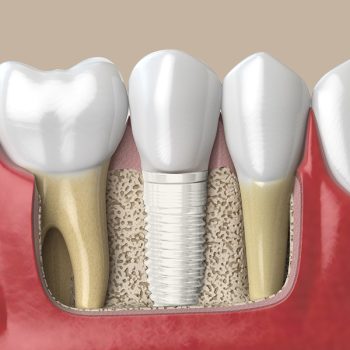 Dental Implants 2c copy